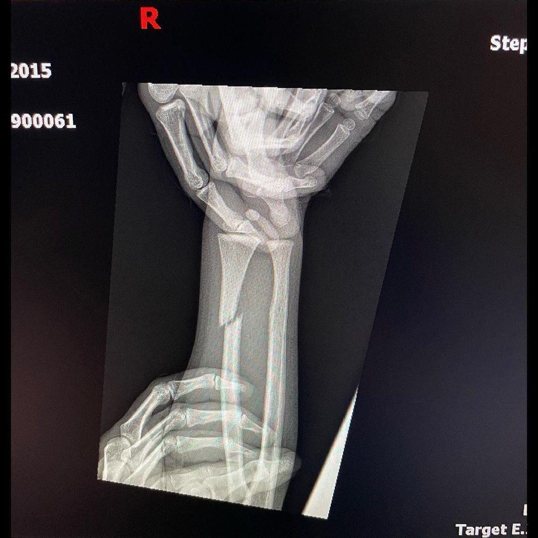 Kanye West Posts Brutal X-Ray Pictures Of Son Saint’s Broken Arm!