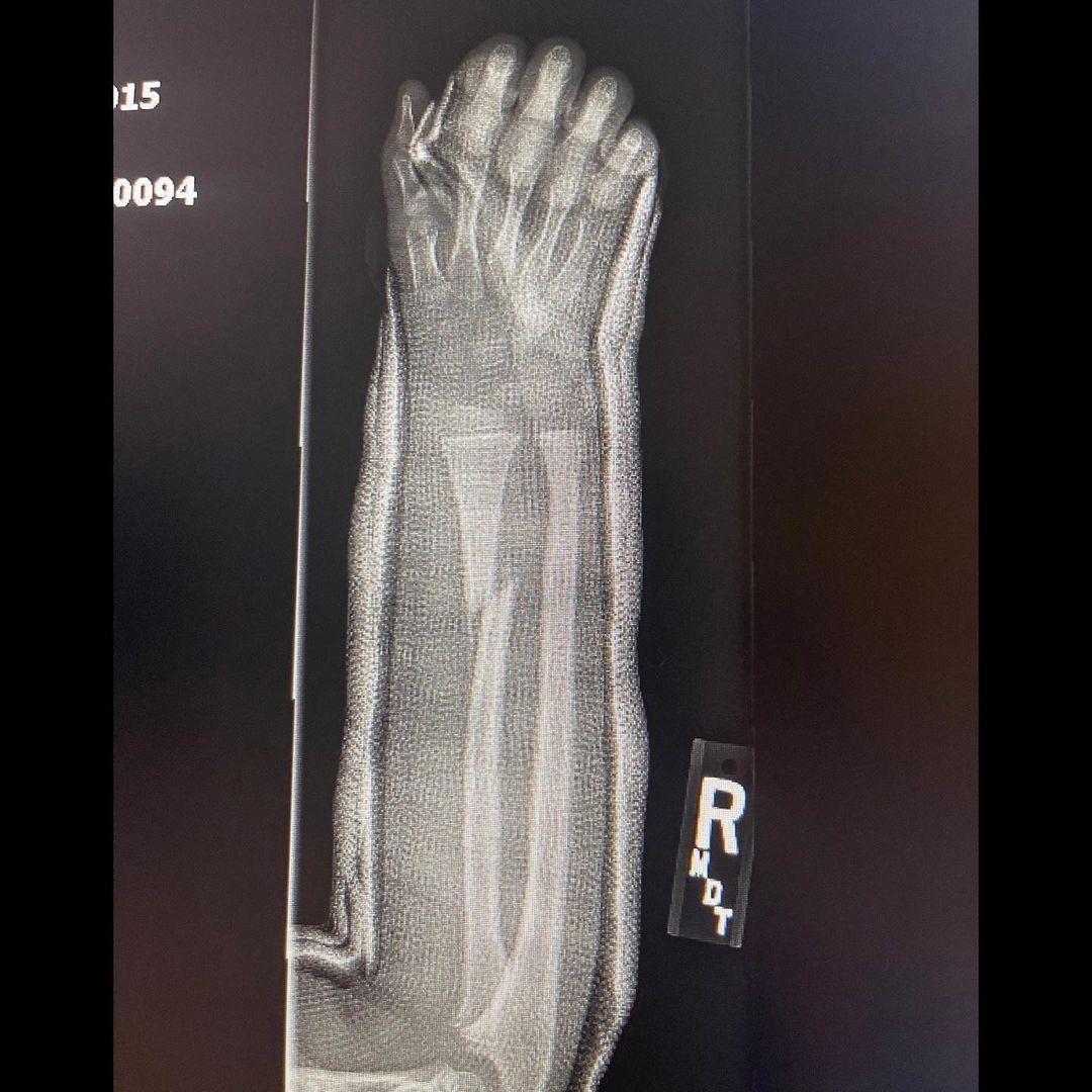 Kanye West Posts Brutal X-Ray Pictures Of Son Saint’s Broken Arm!