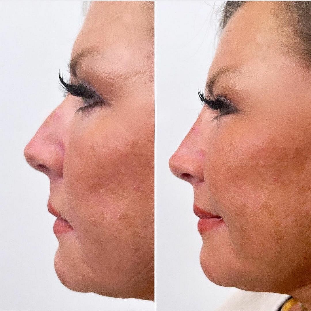 Abby Lee Miller liquid nose job