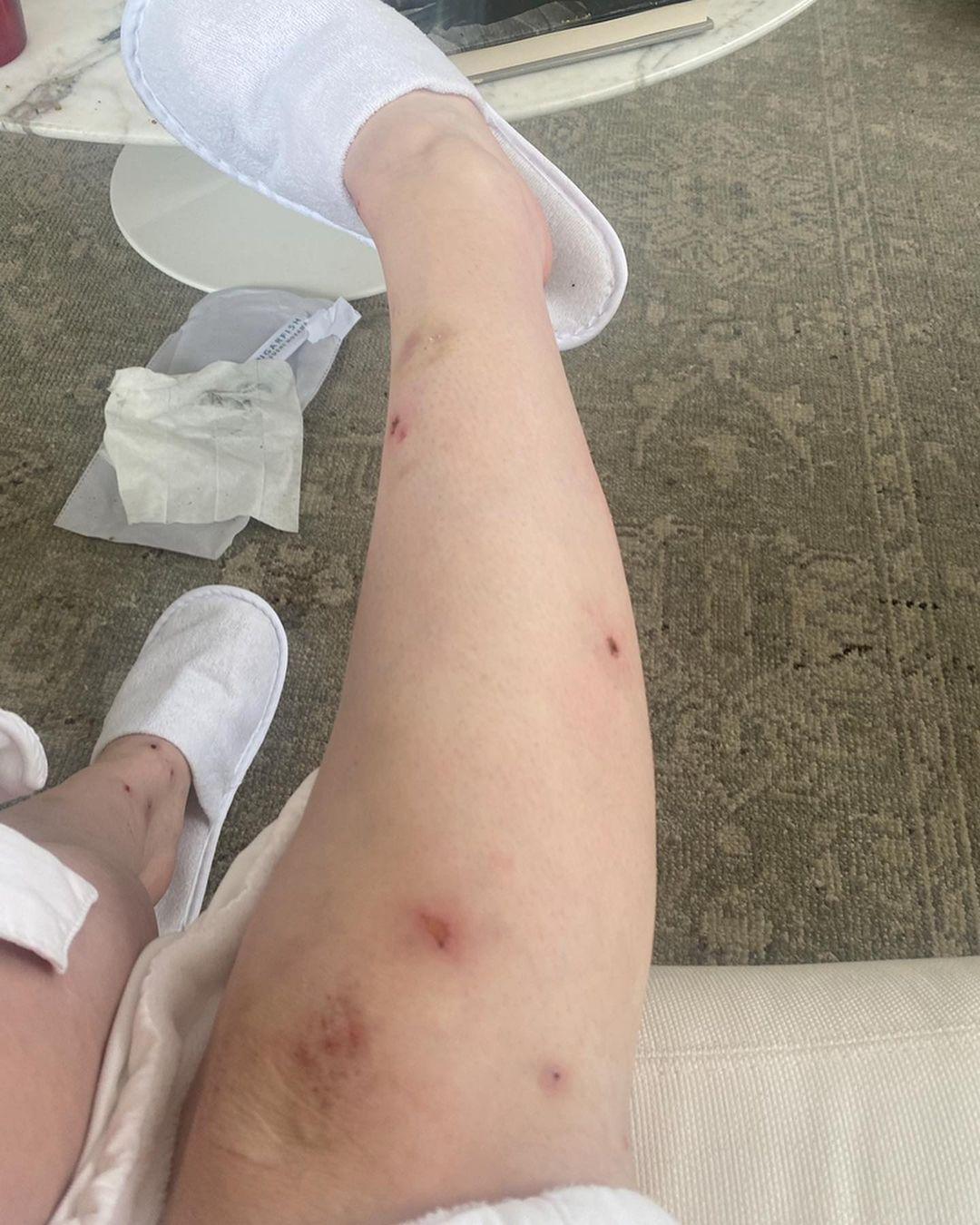 Abigail Breslin Shows Off BRUTAL Mosquito Bites, I Got ‘Eaten Alive!’