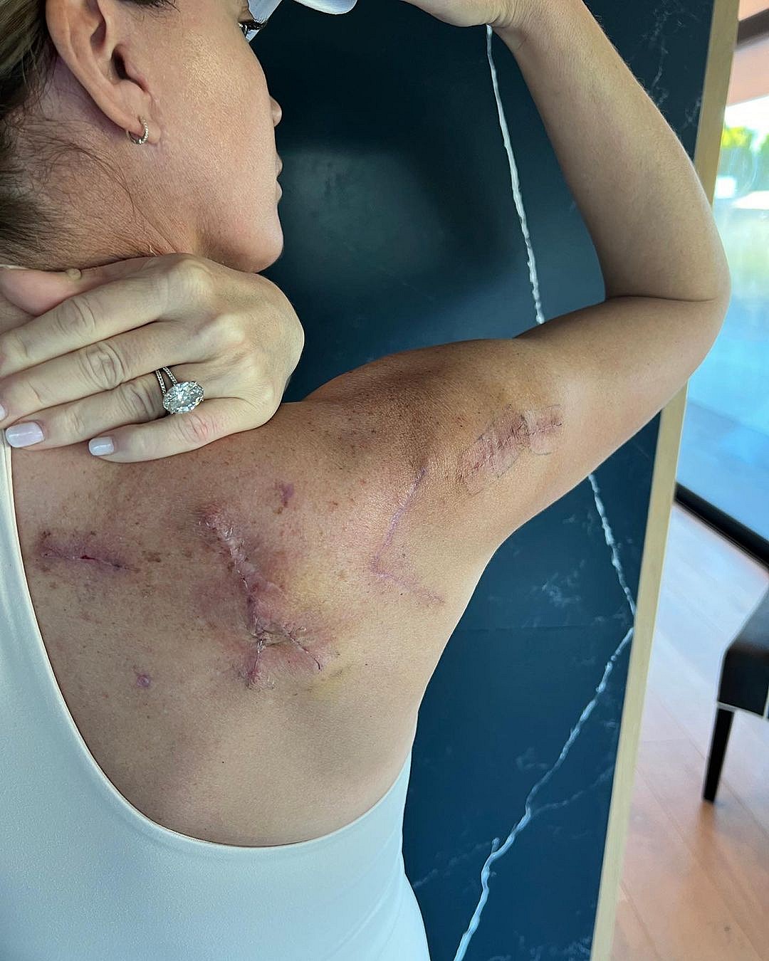 Teddi Mellencamp's melanoma update