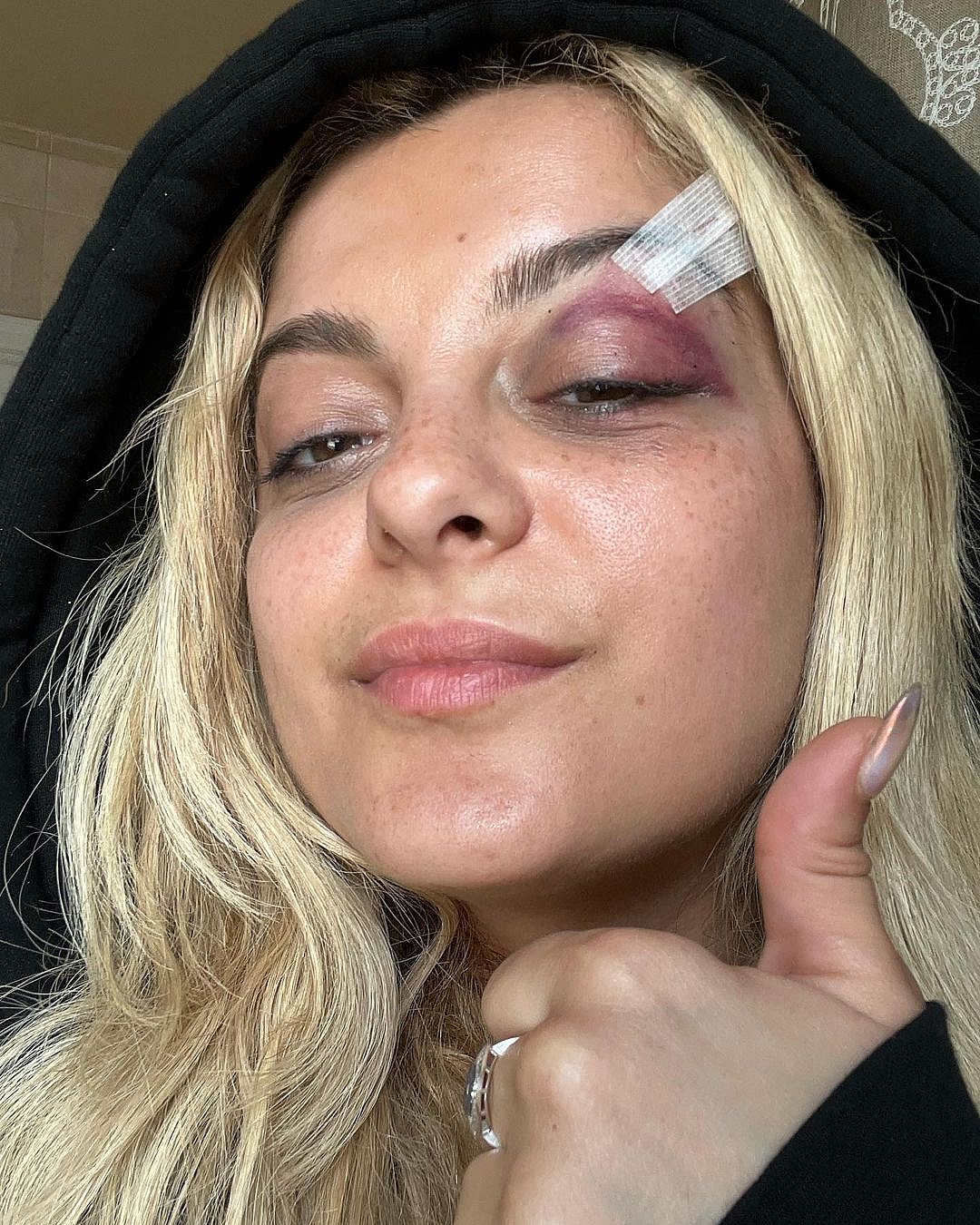 Bebe Rexha Shows Off Shiner After Getting Smashed In The Eye