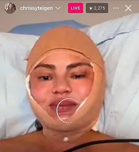 Chrissy Teigen with her face wrapped in bandage