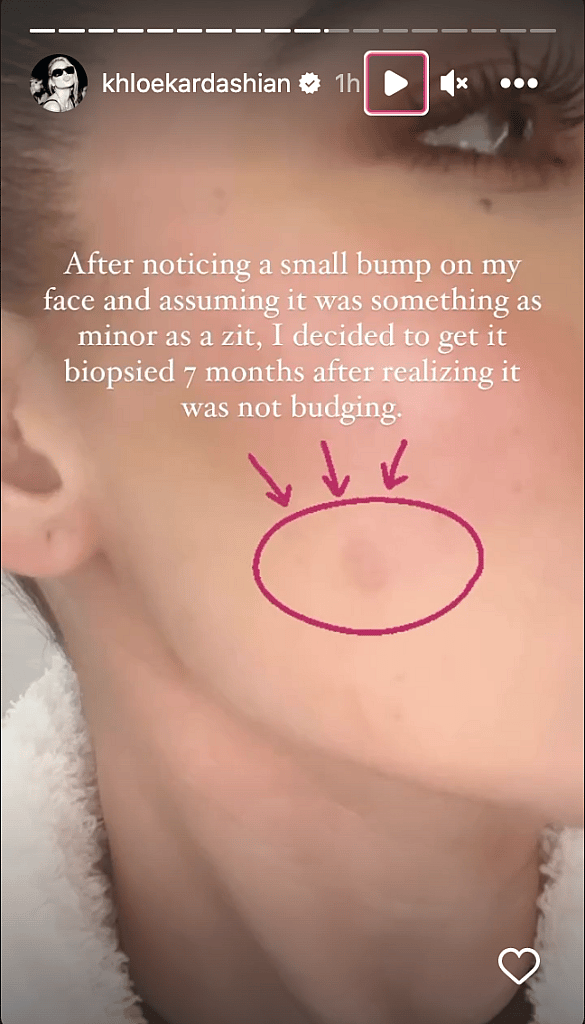 Khloe Kardashian had a tumor on face