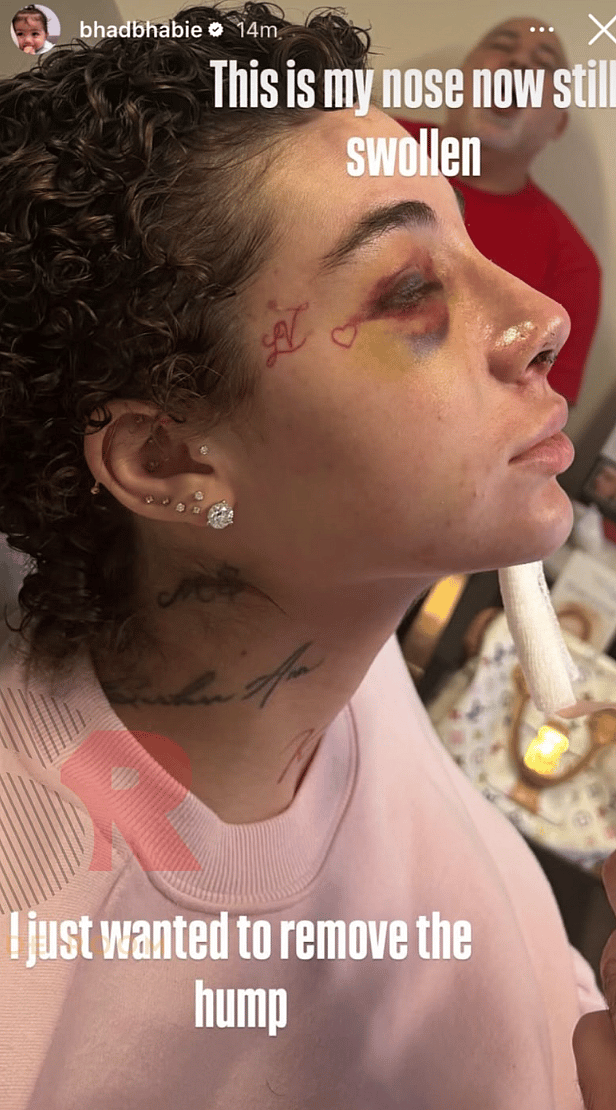 Bhad Bhabie shows off bruising from nose job
