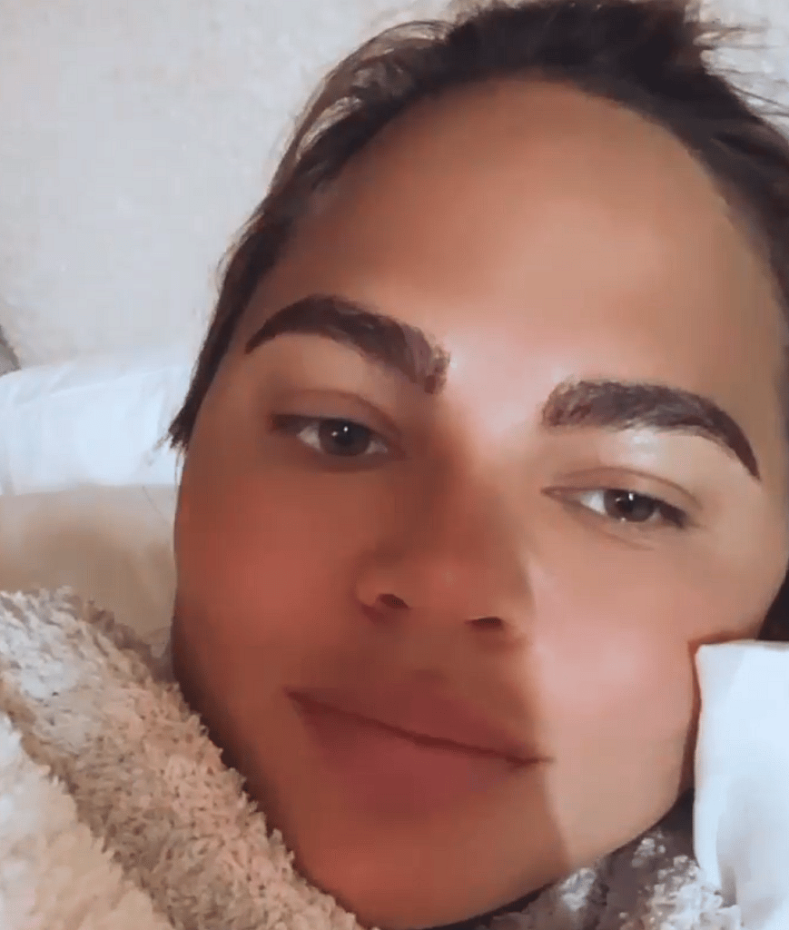 Chrissy Teigen Undergoes An Eyebrow Transplant Surgery, See The Results!