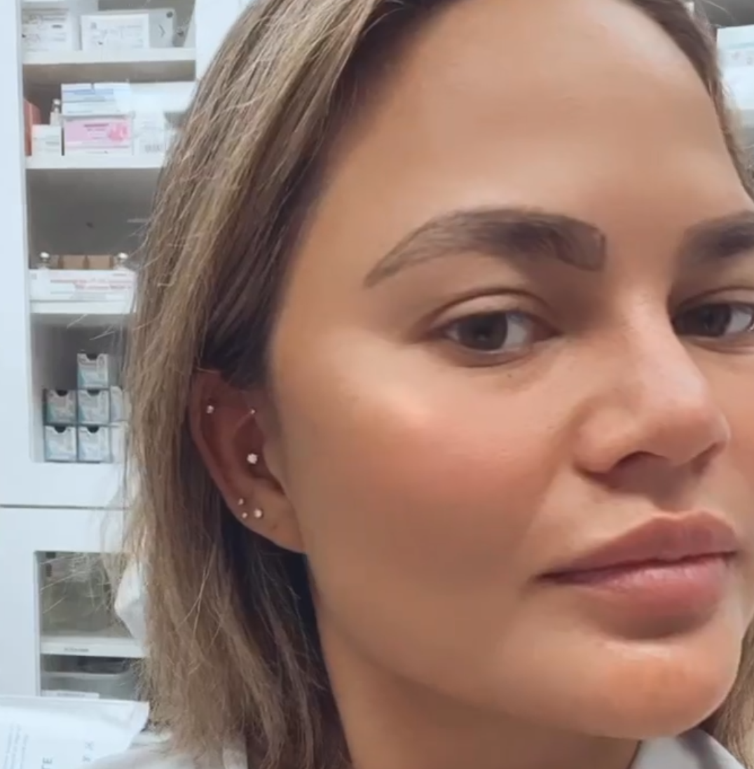 Chrissy Teigen Undergoes An Eyebrow Transplant Surgery, See The Results!