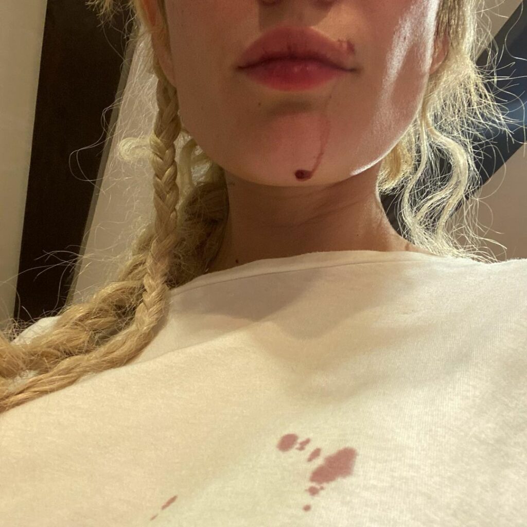 Halsey Bloodied