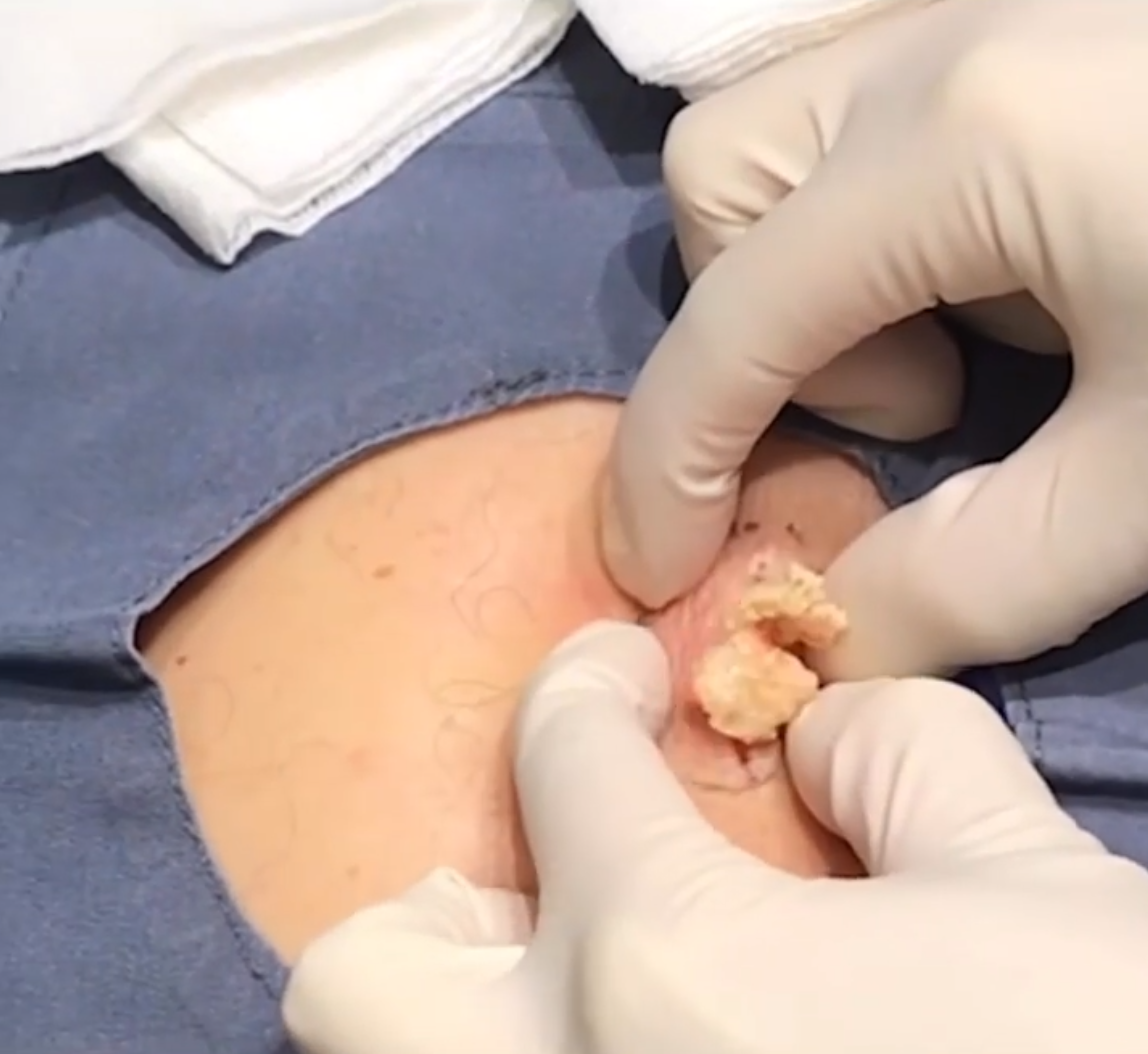 Dr. Pimple Popper -- Massive Explosion Looks Like 'Ricotta Stuffed Shells'