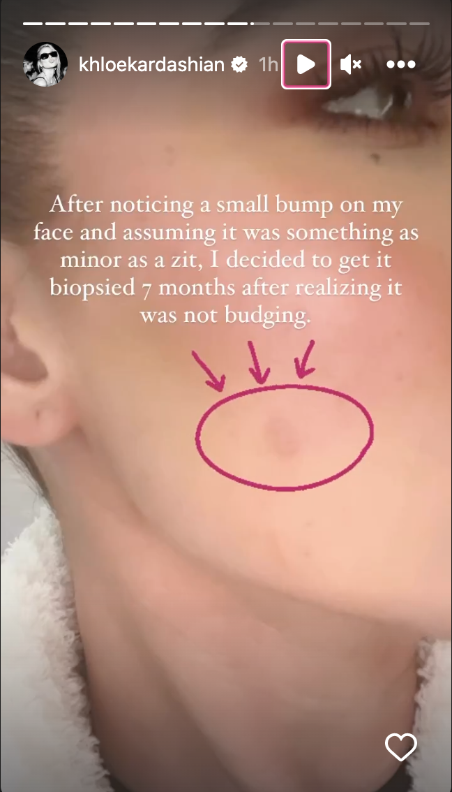 Khloe Kardashian had a tumor on face