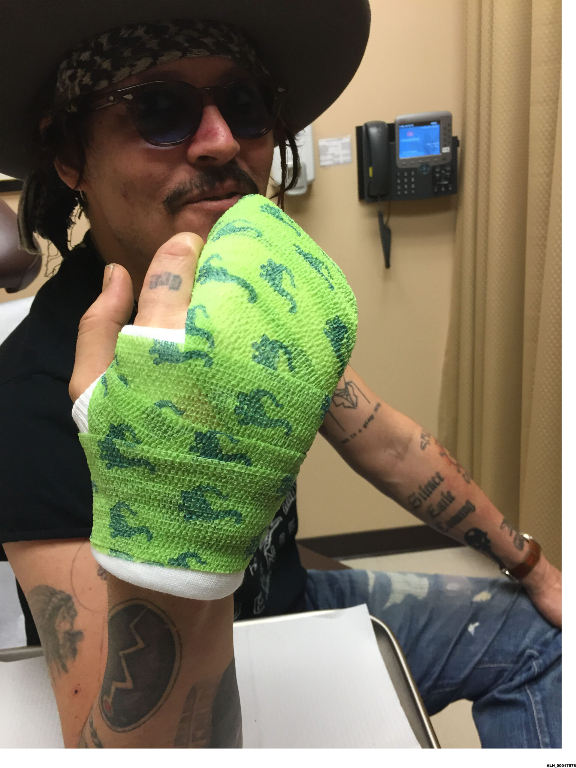 johnny depp loses his finger