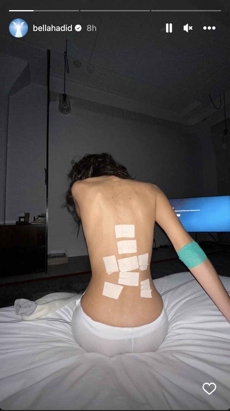 Has Bella Hadid's Lyme Disease Worsened? She Is Bruised And Battered In IG Story