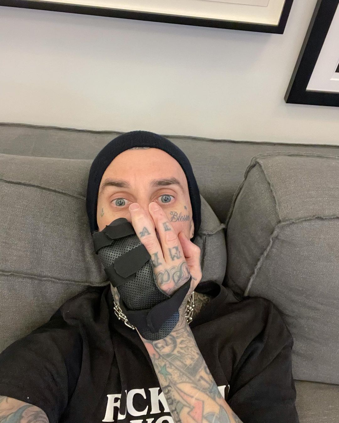 Travis Barker shows broken finger