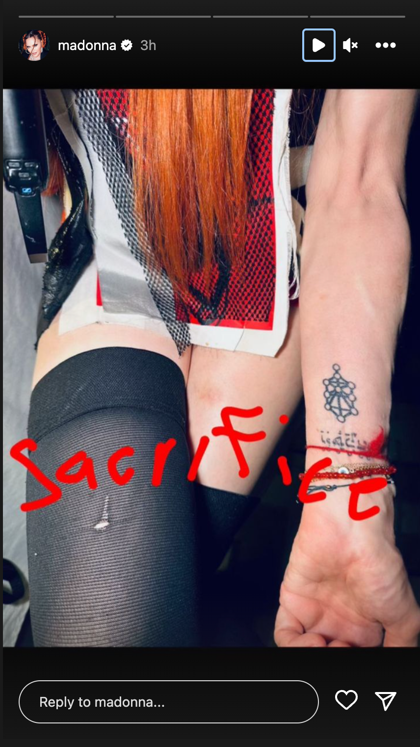 Madonna sports bruise during rehearsal