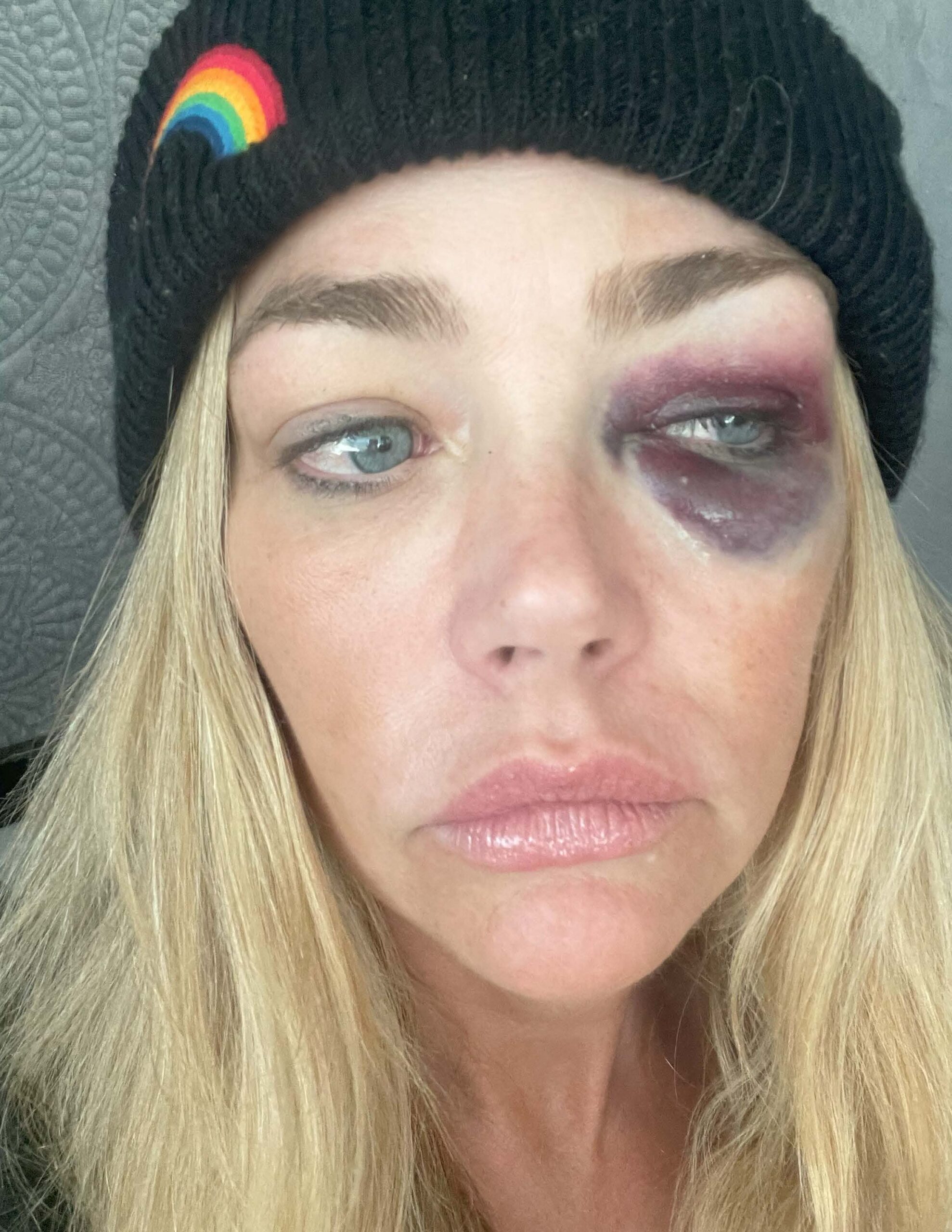 Denise Richards reveals nasty eye injury photos in domestic violence restraining order filing amid bitter split from Aaron Phypers.