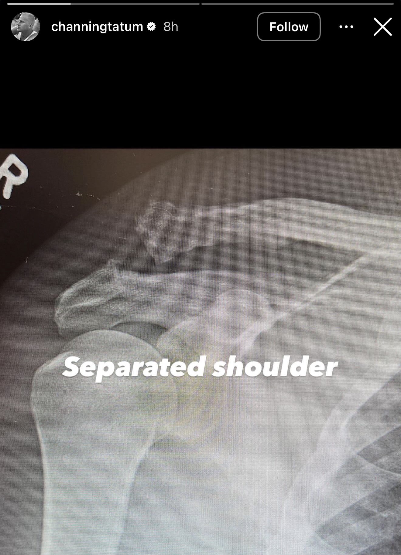 Channing Tatum reveals shoulder injury