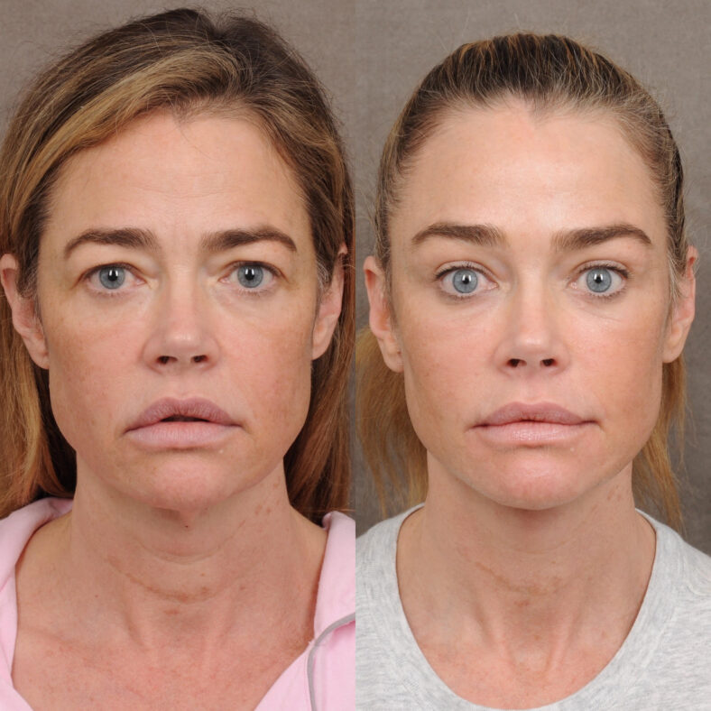 Denise Richards shows off the stunning results of her facelift